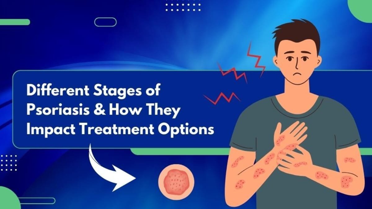 Different Stages of Psoriasis and How They Impact Treatment Options